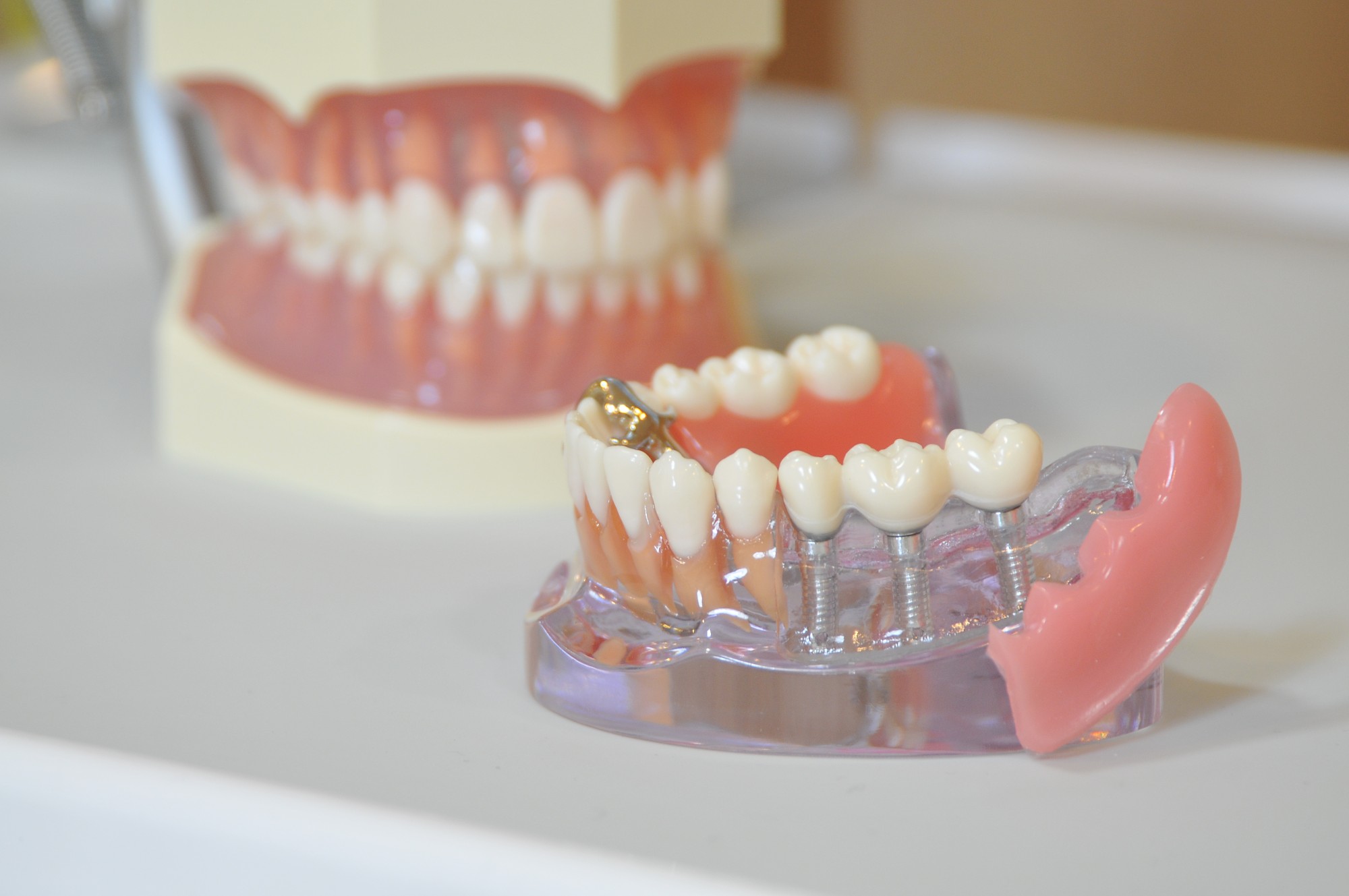 青葉台の歯医者、うかい歯科医院のインプラント治療