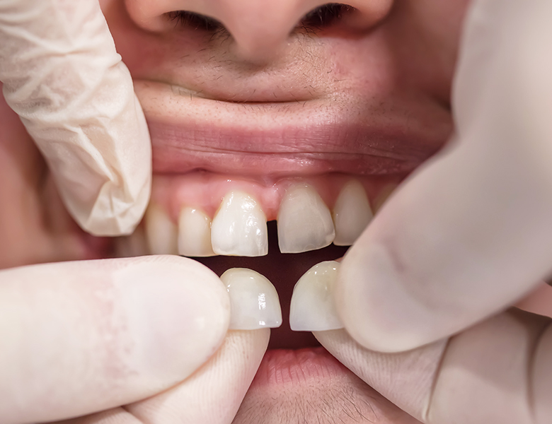 青葉台の歯医者、うかい歯科医院の矯正歯科治療